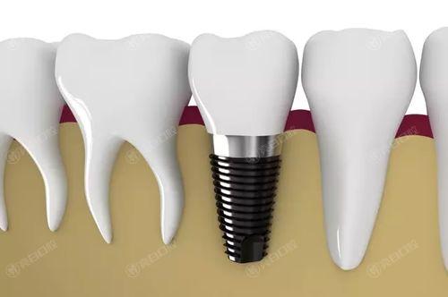 眉山2024种植牙三大口腔医院排名，这三家牙科正规评价好值得推荐