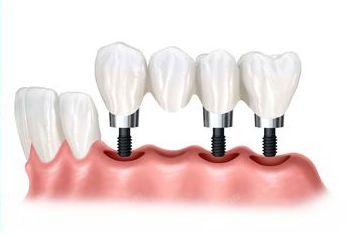 西安评价好的十大口腔医院排名，种植牙技术好评价靠谱的是这十家