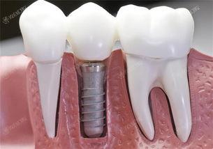 泰州种植牙哪个医院好？2024泰州五大种植牙排行榜泄露