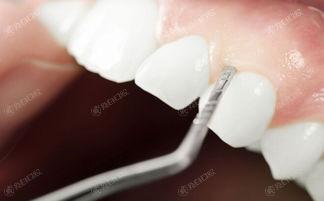 2024福州口腔医院牙齿矫正价格表更新 在口腔医院做德国koheel牙齿矫正器10000